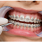 Braces Placement