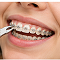 Braces Removal