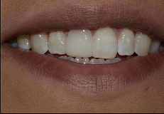 crowns-and-bridges after result