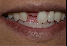 crowns-and-bridges before result
