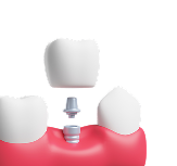 clear-aligners