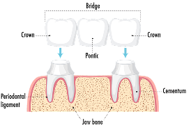 crowns-and-bridges