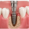 Implant Placement