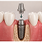 Abutment & Connector