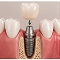 Crown Placement