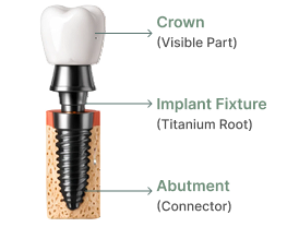 dental-implant