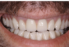 dentures after result