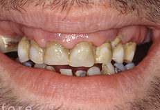 dentures before result