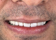 full-mouth-rehabilitation after result
