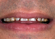 full-mouth-rehabilitation before result