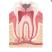 Infected Tooth
