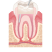 Tooth Reinforced