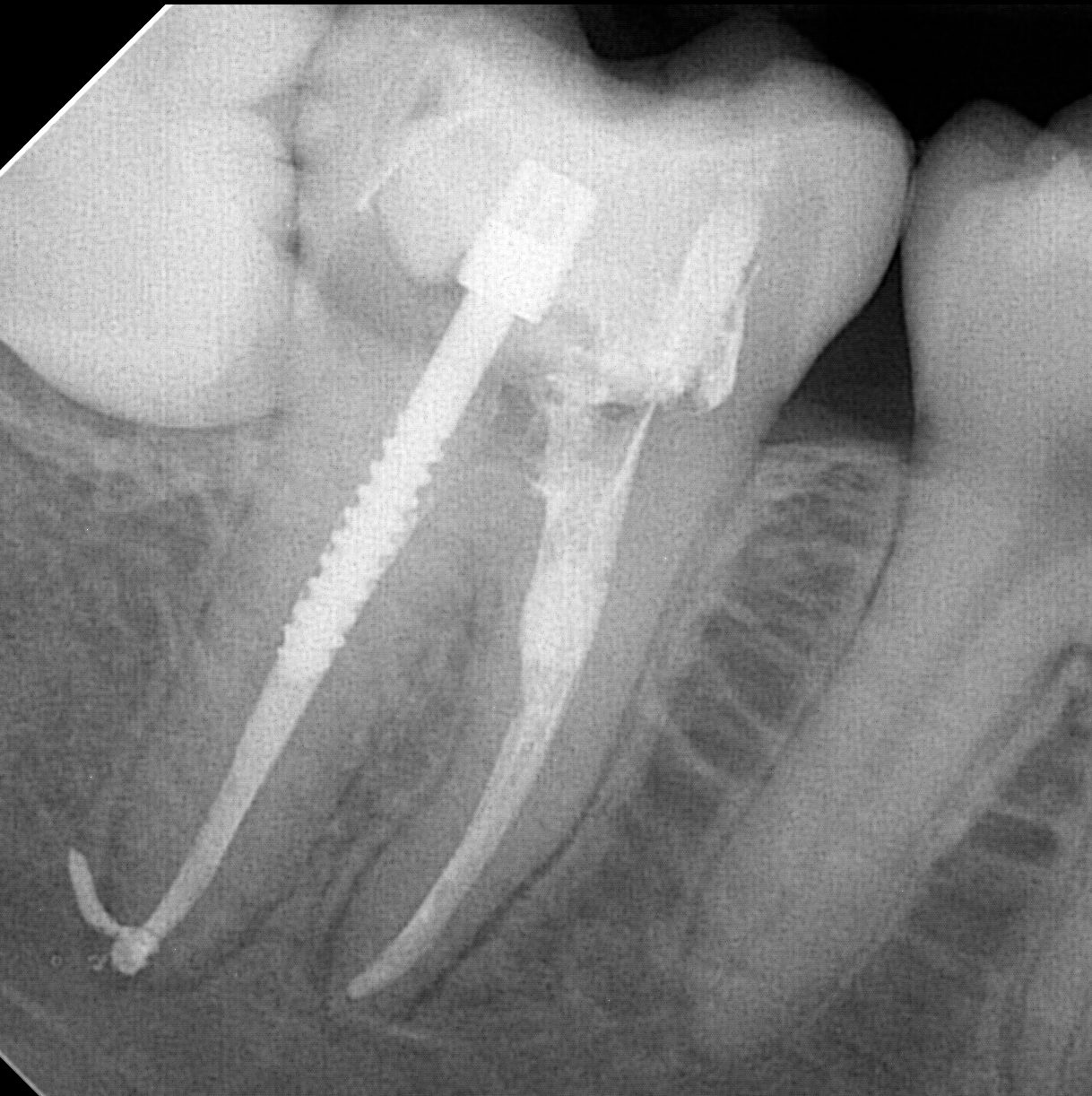 root-canal01.png