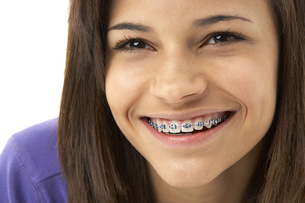 braces