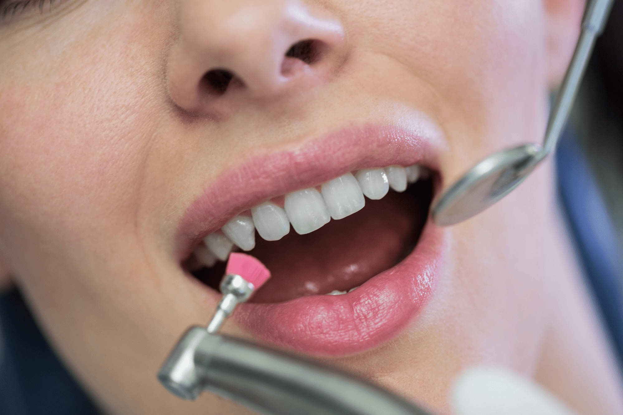 teeth-cleaning