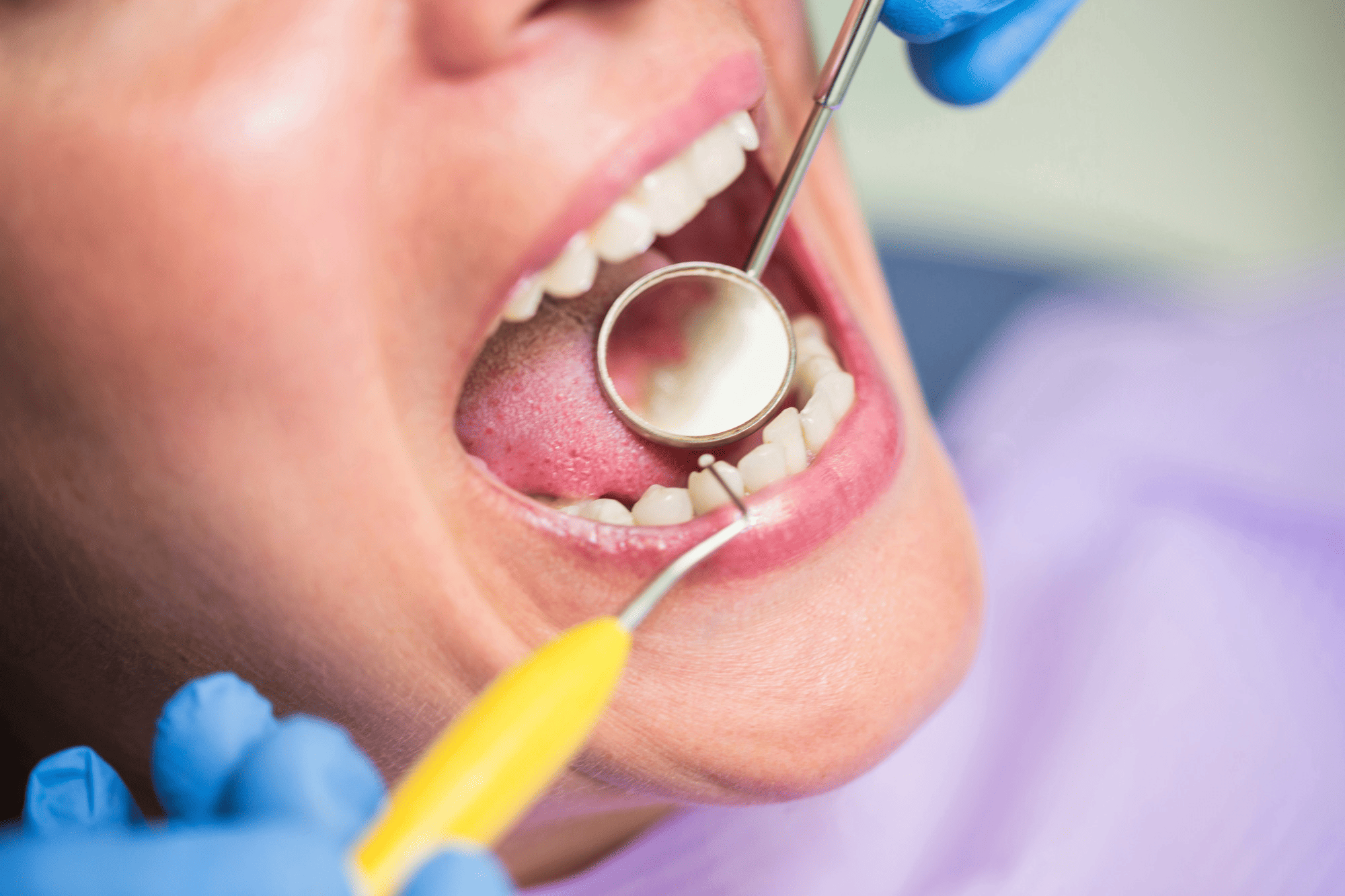 services-tooth-filling