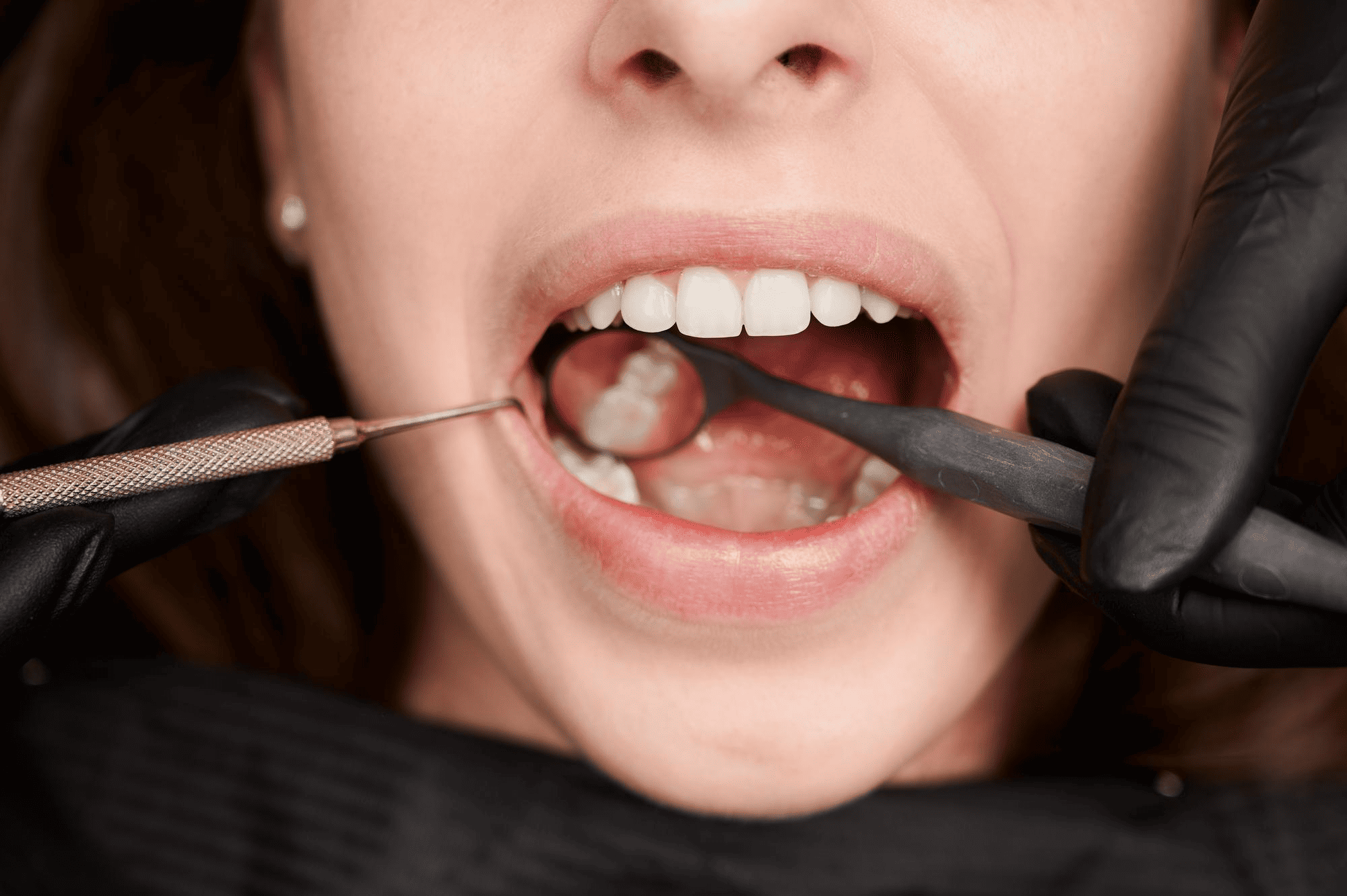 wisdom-teeth-removal