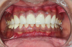 smile-makeover after result