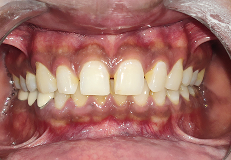 smile-makeover before result