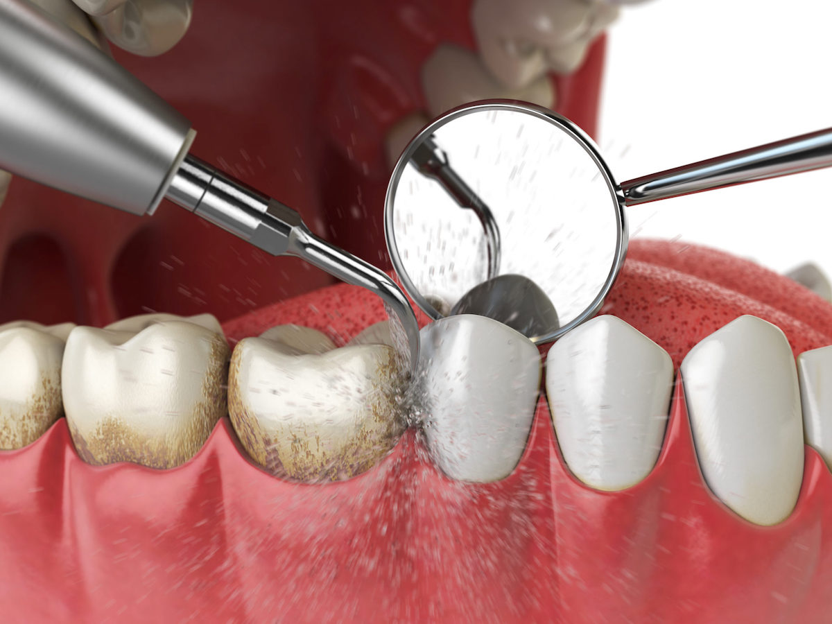 teeth-cleaning