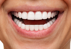 teeth-cleaning after result