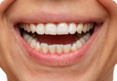 teeth-cleaning before result