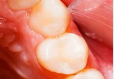 tooth-filling after result