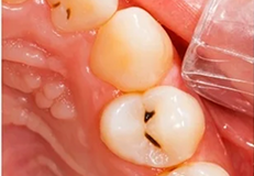 tooth-filling before result