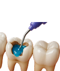 tooth-filling