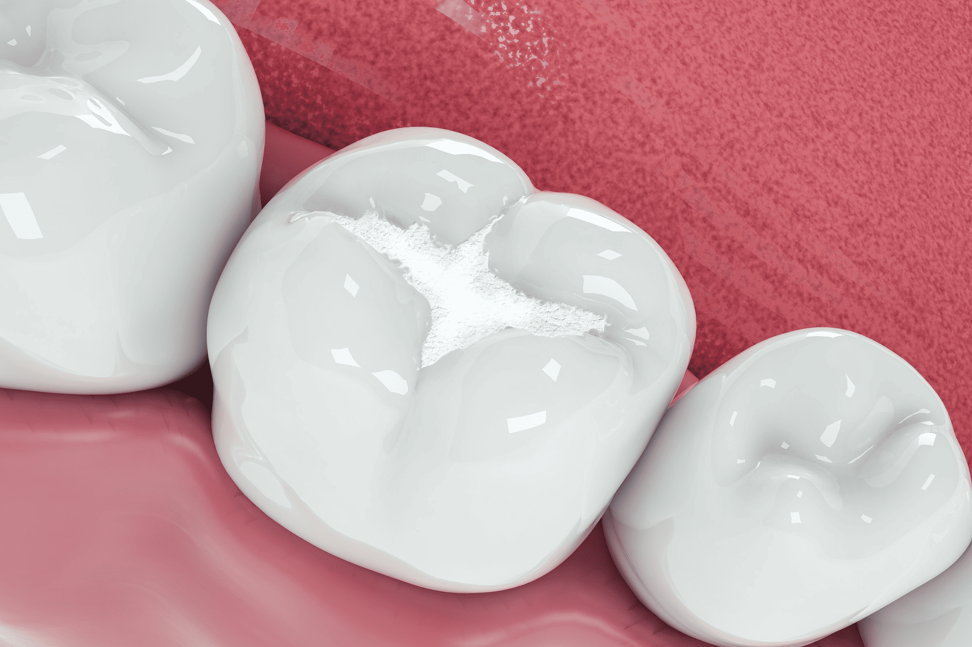 tooth-filling