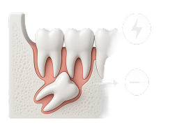 wisdom-teeth-removal